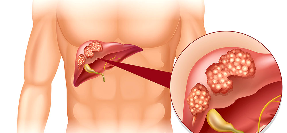 Fruktose mehrt Leberfett